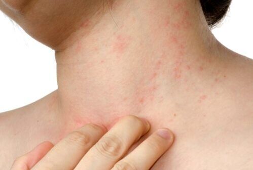 Αλλεργία στα υποδόρια παράσιτα